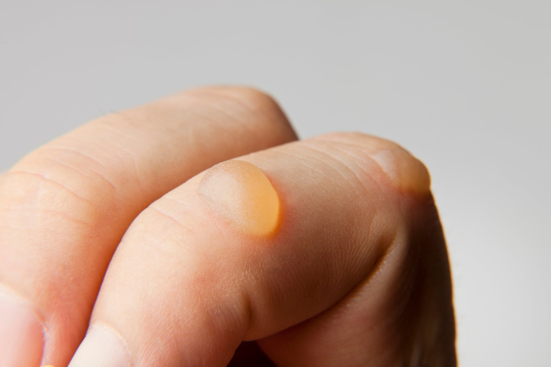 human finger blister